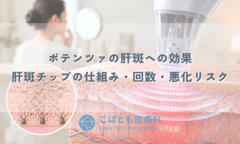 ポテンツァの肝斑への効果 — 肝斑チップの仕組み・回数・悪化リスク