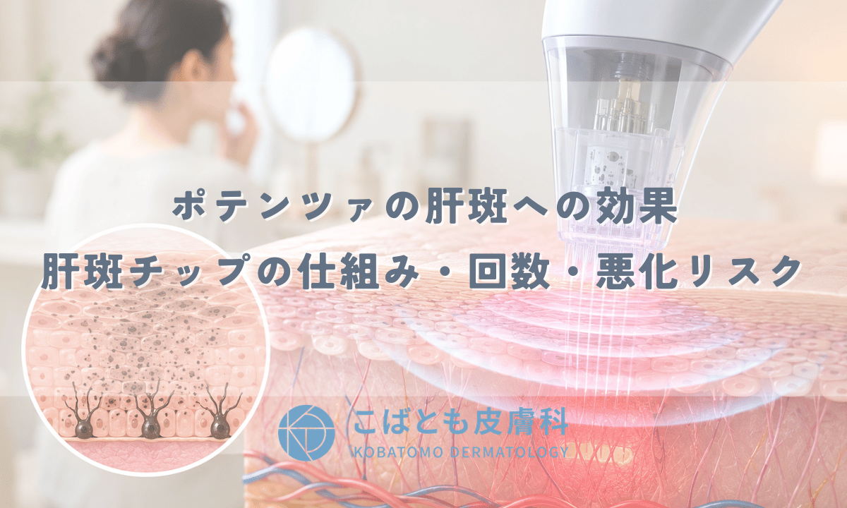ポテンツァの肝斑への効果 — 肝斑チップの仕組み・回数・悪化リスク
