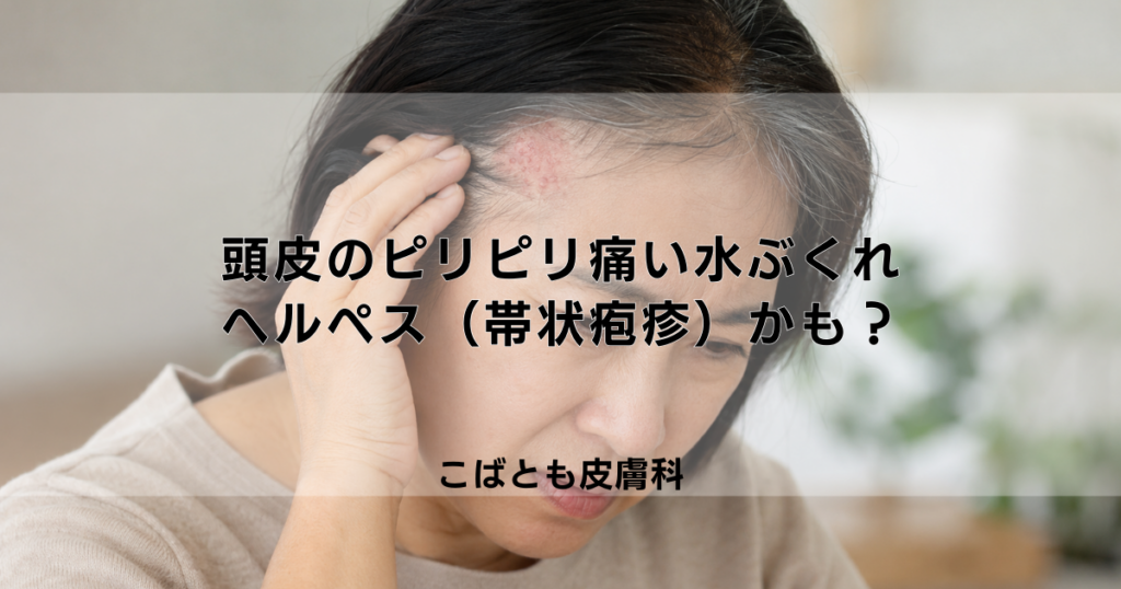 頭皮のピリピリ痛い水ぶくれはヘルペス（帯状疱疹）かも？原因と治療法