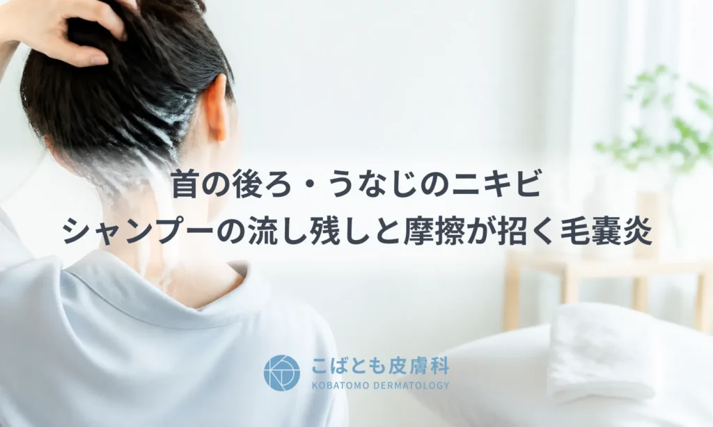 首の後ろ・うなじのニキビ｜シャンプーの流し残しと摩擦が招く毛嚢炎