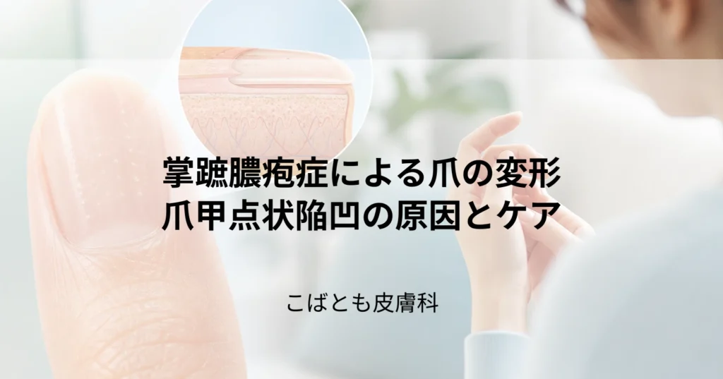 掌蹠膿疱症による爪の変形（爪甲点状陥凹）の原因とケア方法