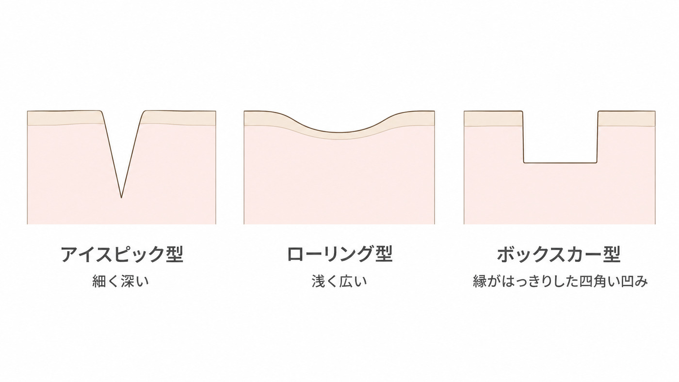ニキビ跡のタイプ