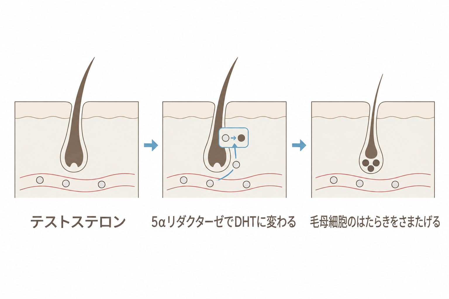 テストステロンが毛包で5αリダクターゼによりDHTに変わり、毛母細胞のはたらきをさまたげる