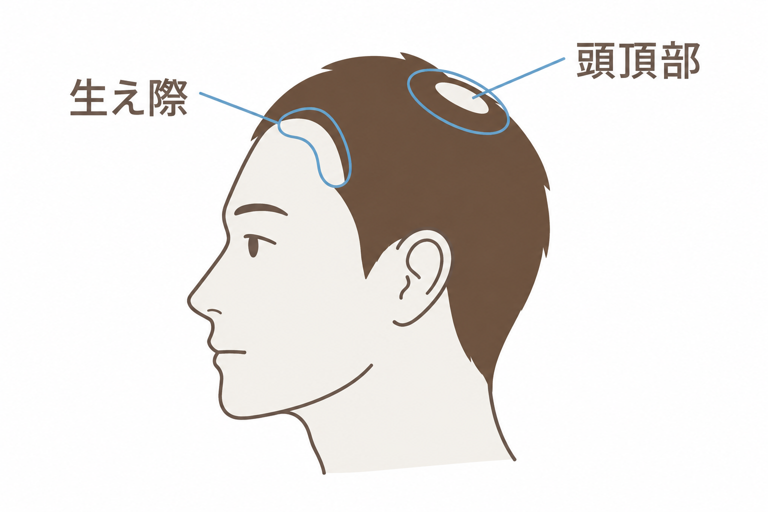 AGAで薄くなりやすい部位。生え際と頭頂部