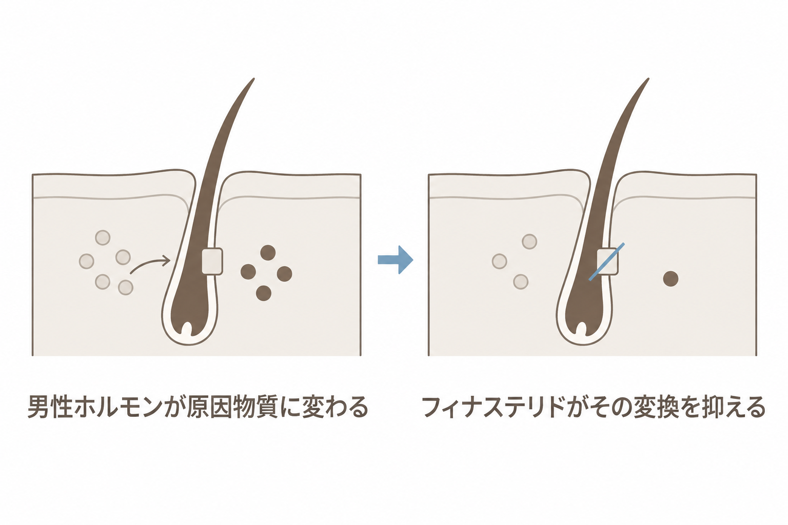 男性ホルモンが原因物質に変わるのを、フィナステリドが抑える