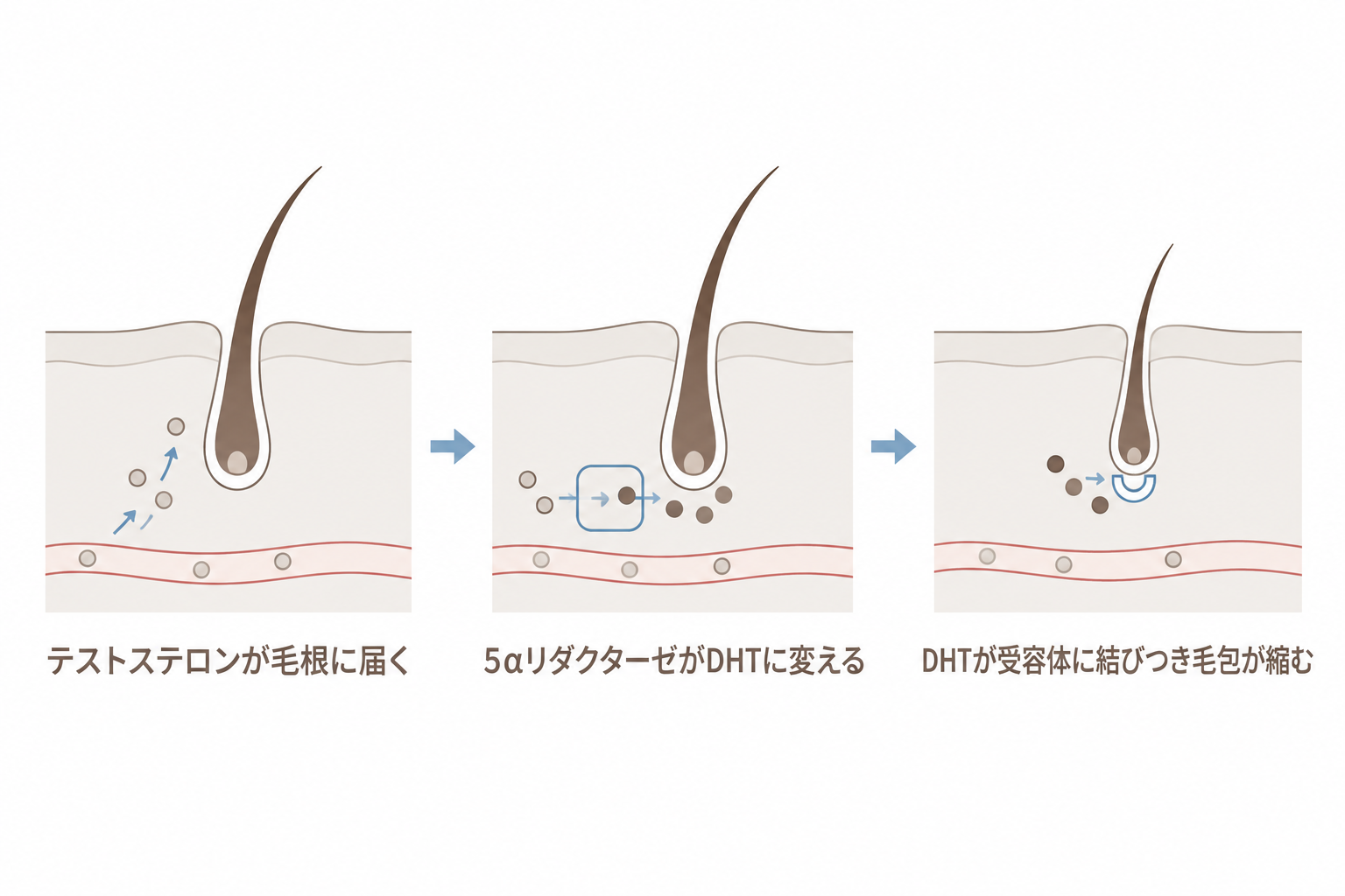テストステロンが5αリダクターゼでDHTに変わり、受容体に結びついて毛包が縮む