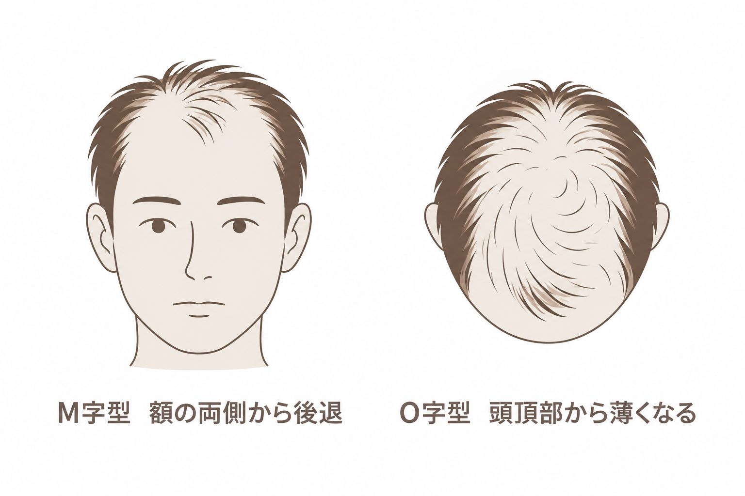 M字型は額の両側から後退し、O字型は頭頂部から薄くなる
