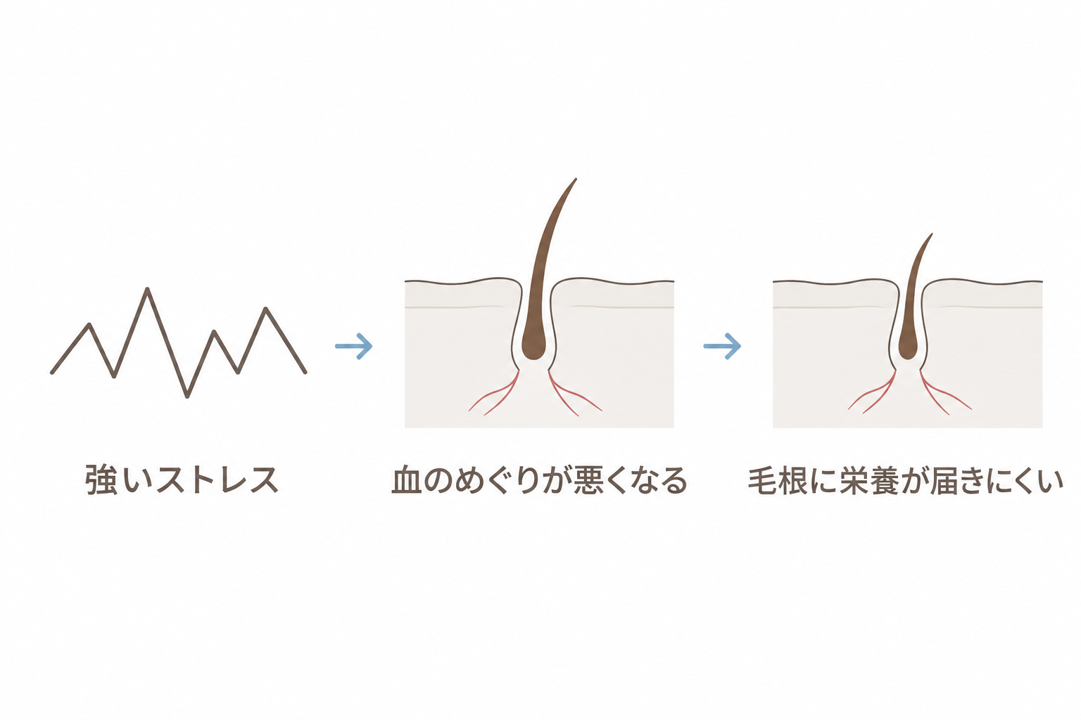 強いストレスで血のめぐりが悪くなり、毛根に栄養が届きにくくなる