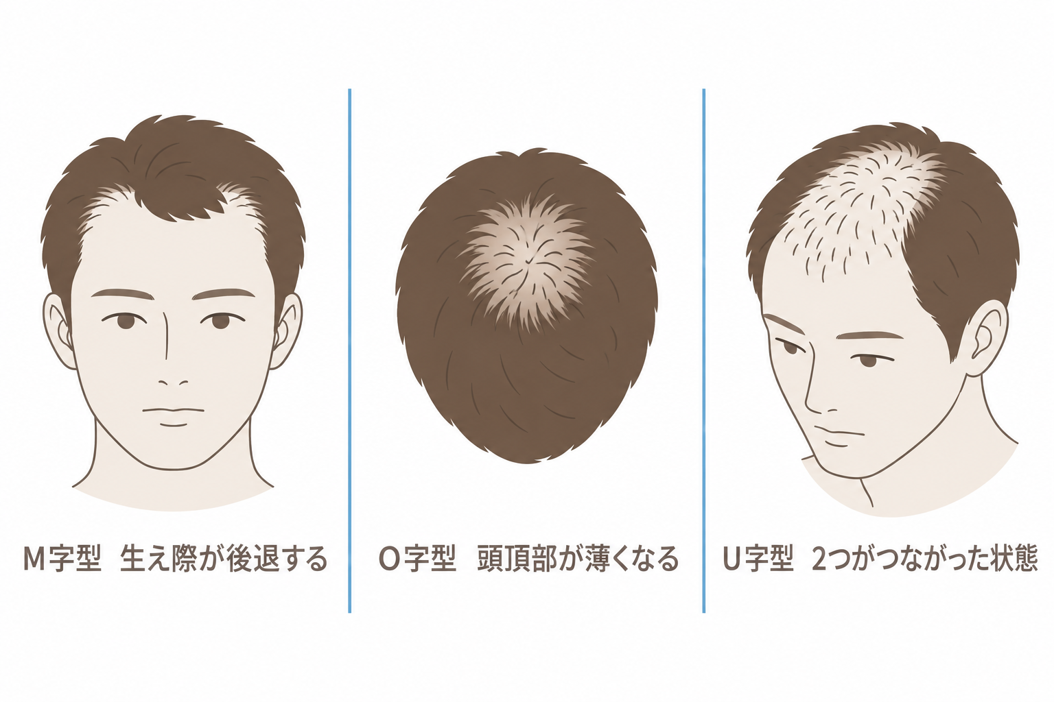 薄毛の進行パターン。M字型・O字型・U字型
