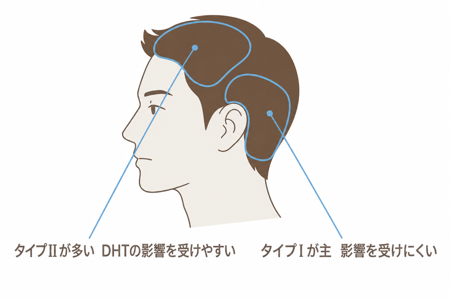 前頭部と頭頂部はタイプⅡが多くDHTの影響を受けやすい