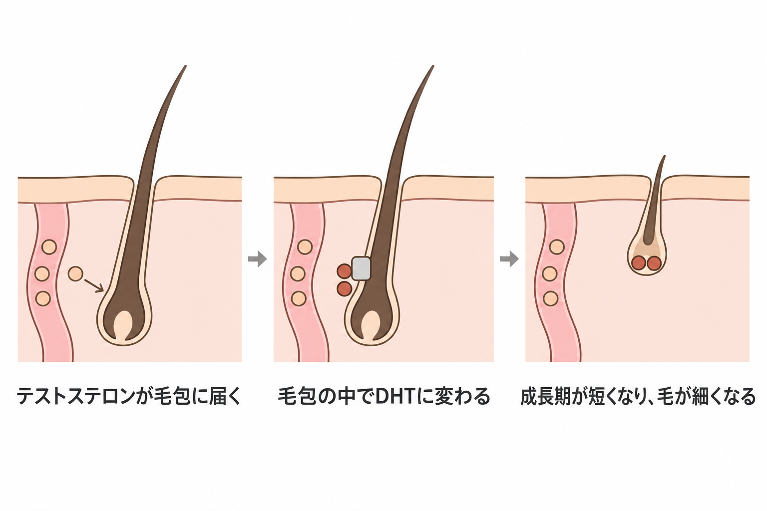 テストステロンが毛包に届き、毛包の中でDHTに変わって毛が細くなる流れ