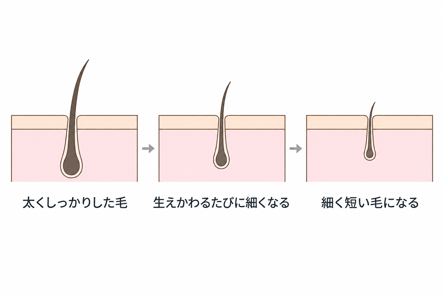 毛が生えかわるたびに細く短くなっていく毛包の断面
