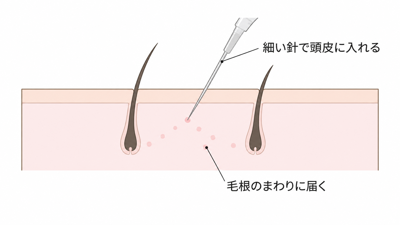 細い針で頭皮に薬を入れ、毛根のまわりに届くようす