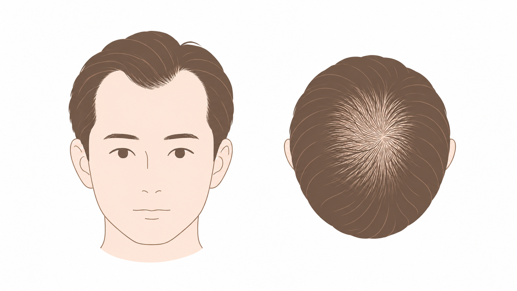 AGAが進んだ中間の段階。生え際の後退と頭頂部の薄まり