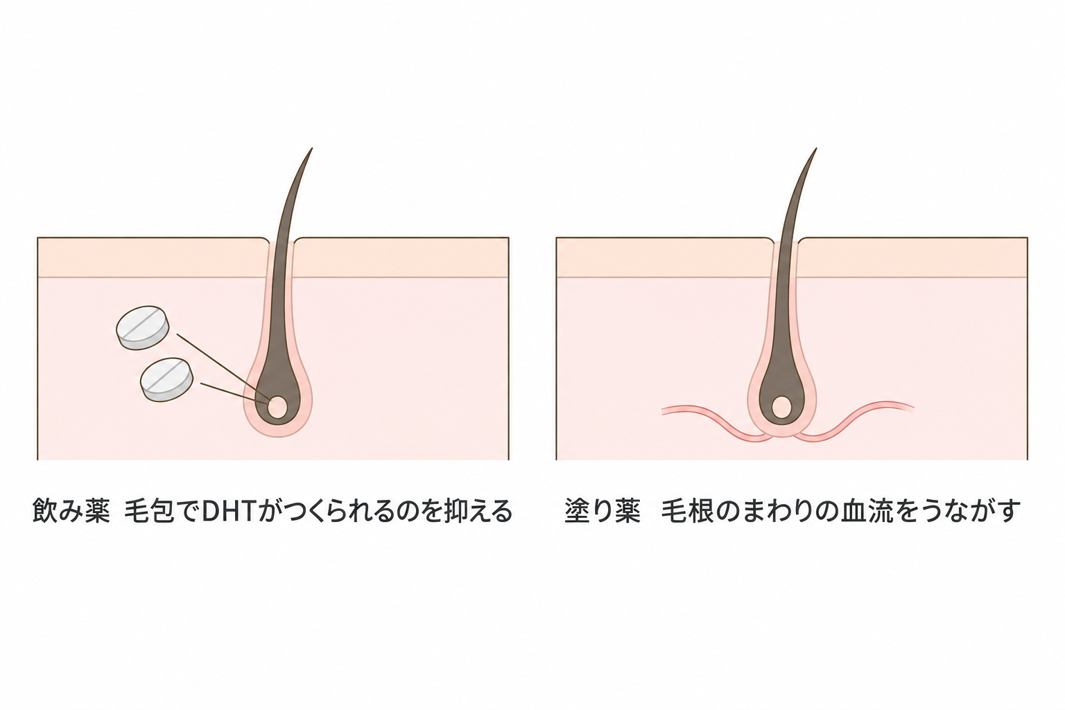 飲み薬は毛包でDHTがつくられるのを抑え、塗り薬は毛根のまわりの血流をうながす