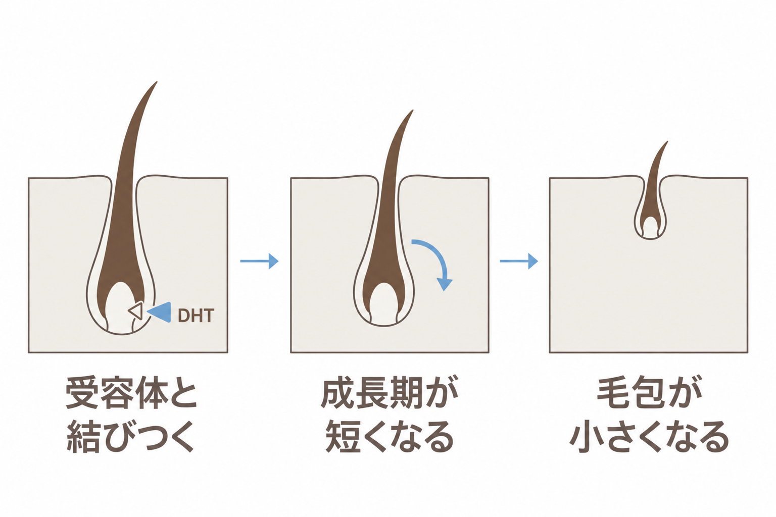 DHTが毛乳頭の受容体と結びつき、成長期が短くなって毛包が小さくなる