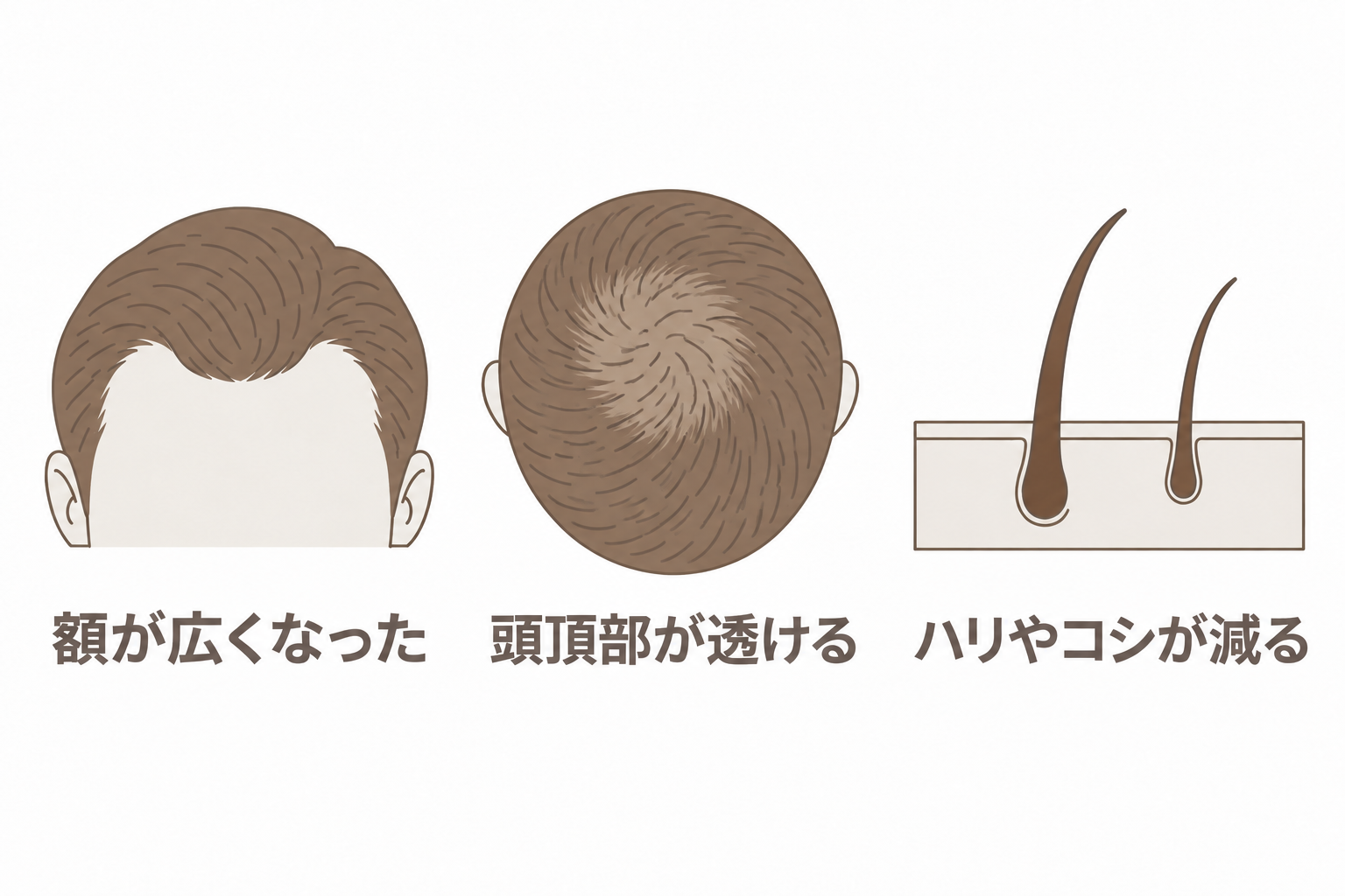 額が広くなった、頭頂部が透ける、ハリやコシが減るというAGAのサイン