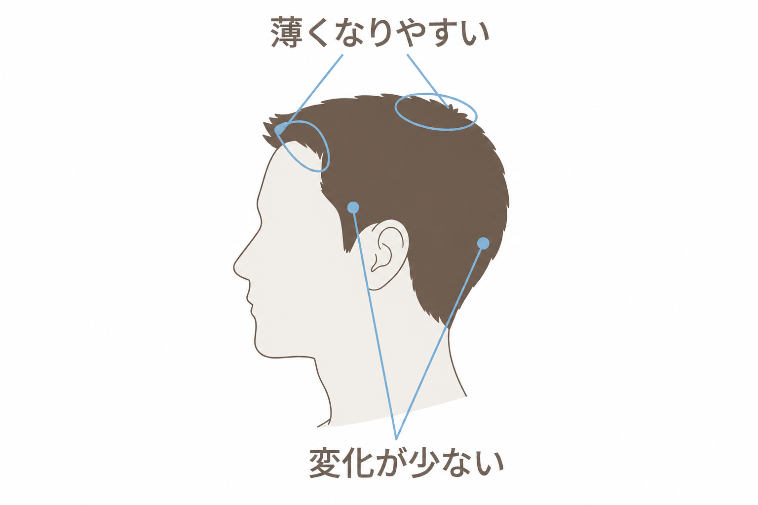 AGAは生え際と頭頂部が薄くなりやすく、側頭部と後頭部は変化が少ない
