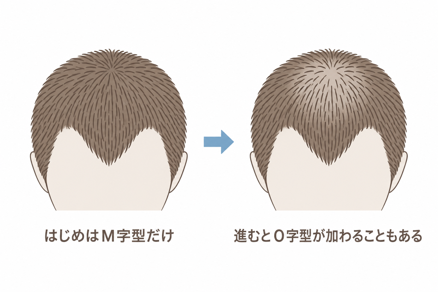 はじめはM字型だけでも、進むとO字型が加わることがある