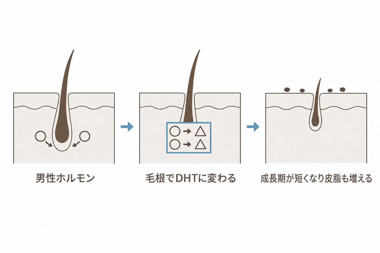 男性ホルモンが毛根でDHTに変わり、成長期が短くなって皮脂も増える