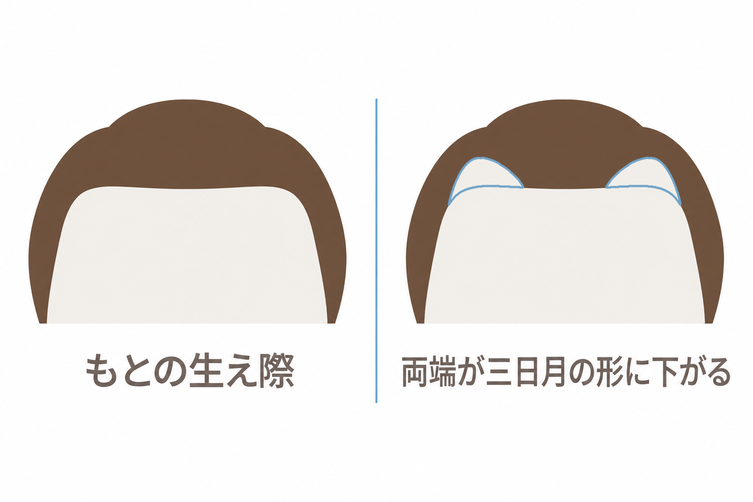 もとの生え際と、両端が三日月の形に下がったM字型の生え際