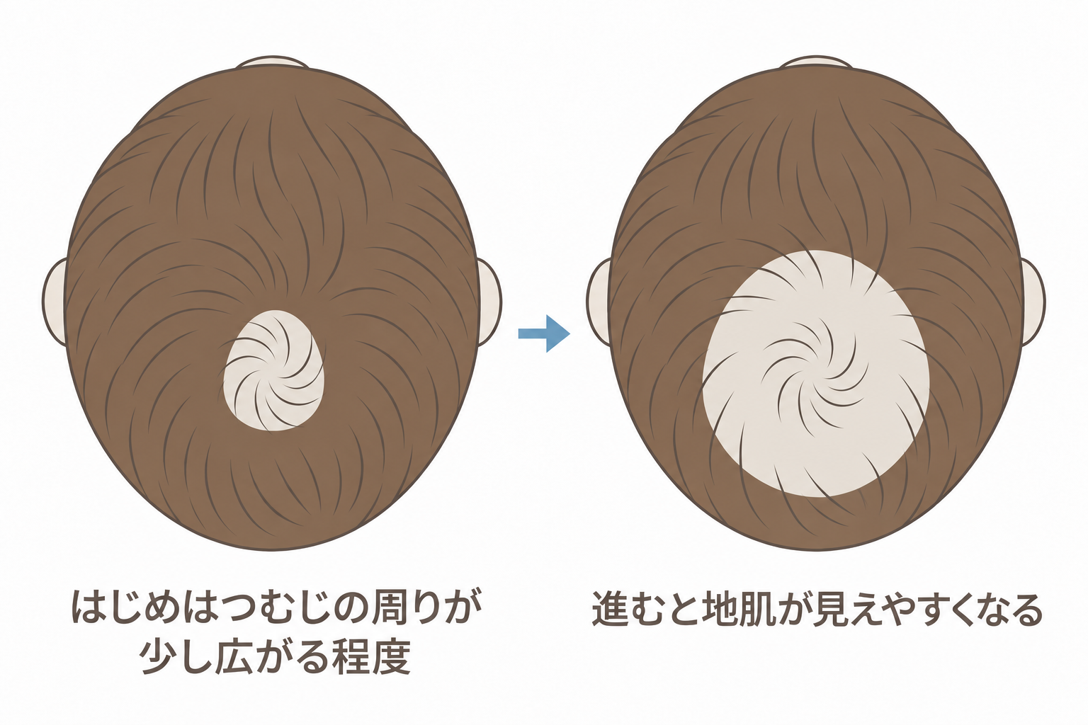 はじめはつむじの周りが少し広がる程度で、進むと地肌が見えやすくなる