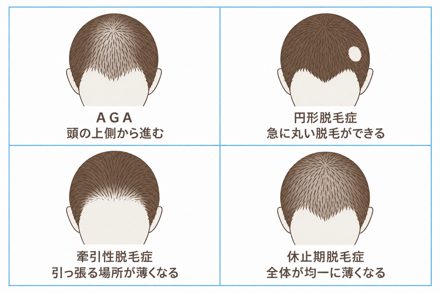AGA以外の脱毛症。円形脱毛症、牽引性脱毛症、休止期脱毛症との違い