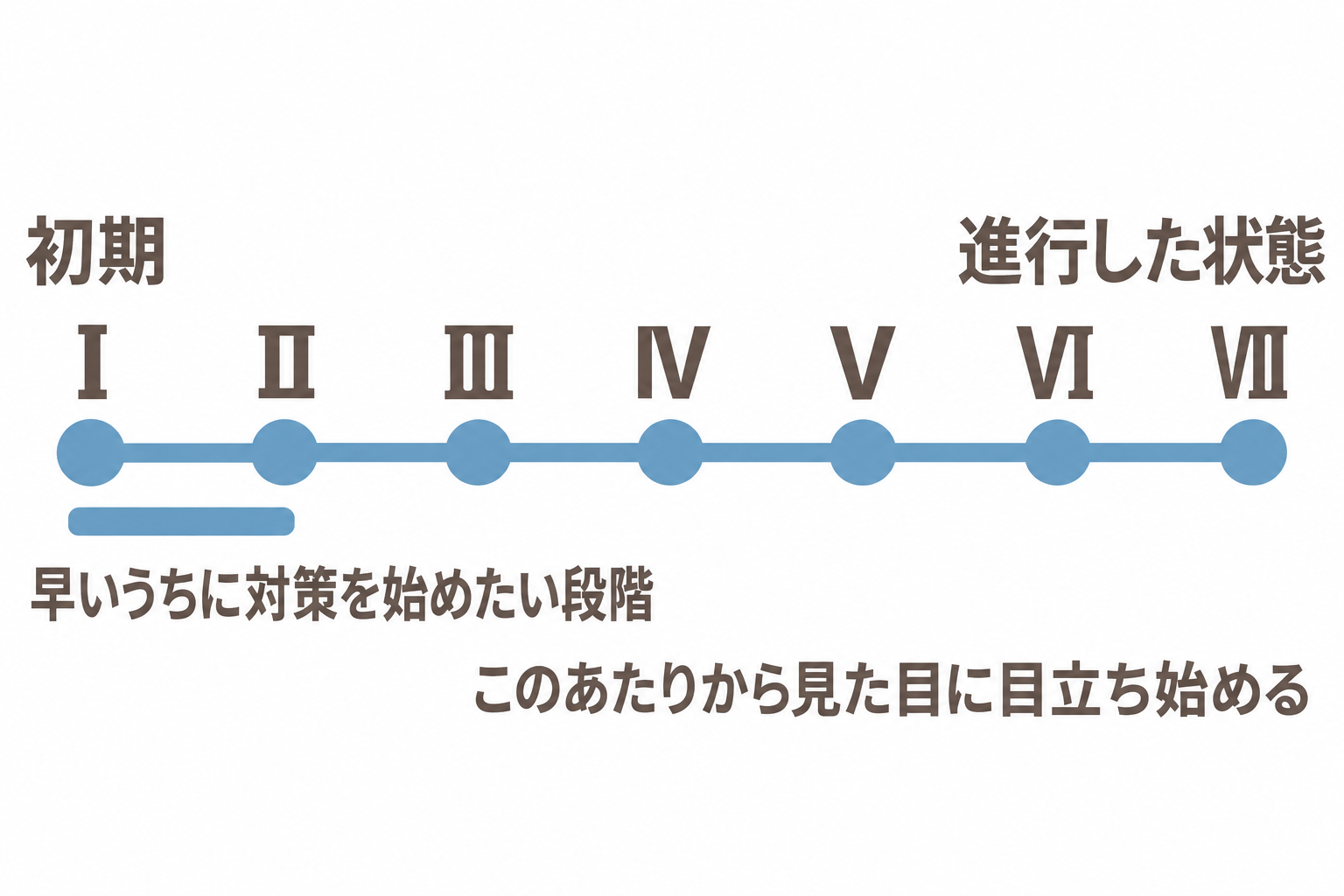 ハミルトン・ノーウッド分類の進行度。Ⅰ〜Ⅱが早いうちに対策を始めたい段階、Ⅲあたりから見た目に目立ち始める