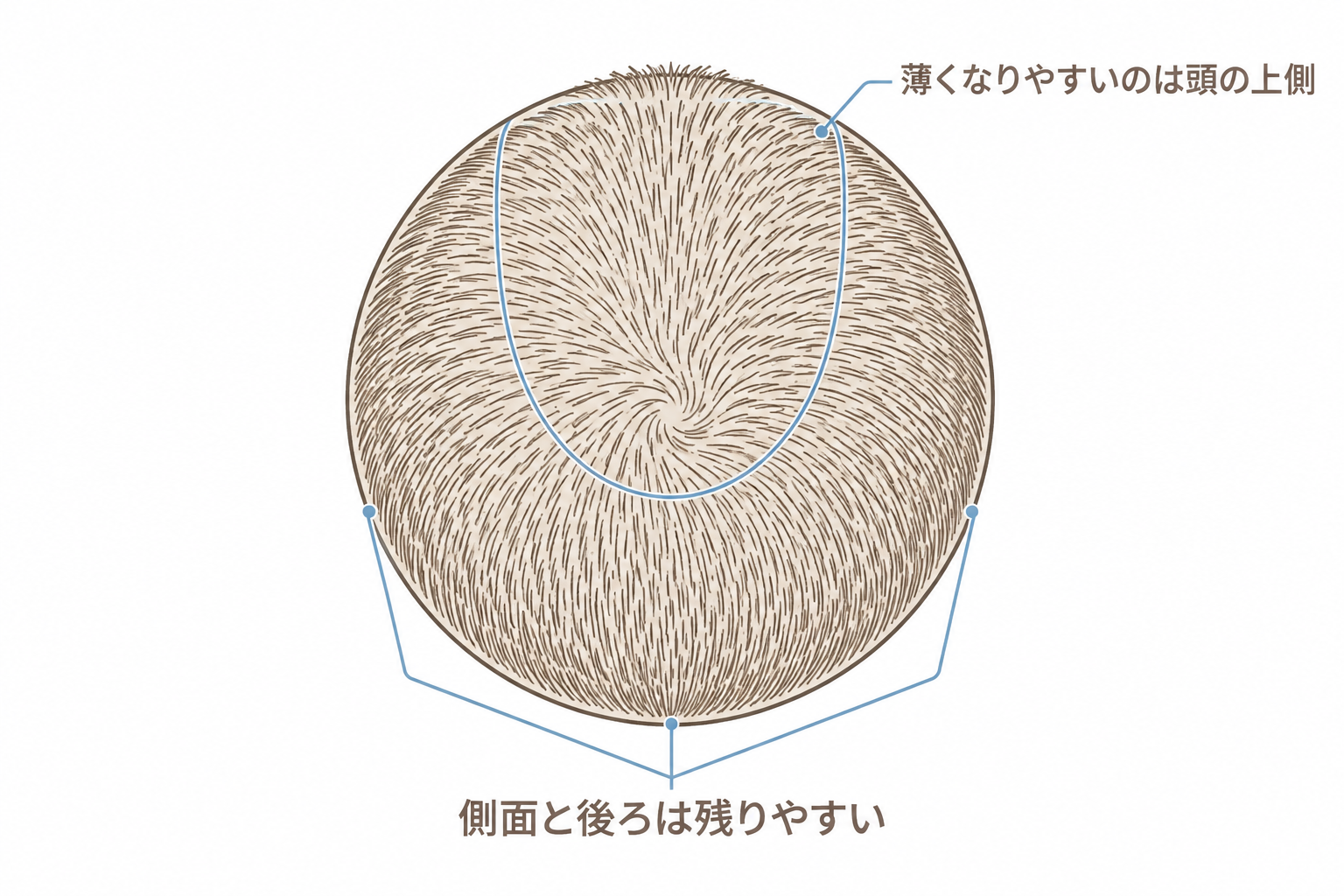 頭を上から見たとき、薄くなりやすいのは頭の上側で、側面と後ろは残りやすい