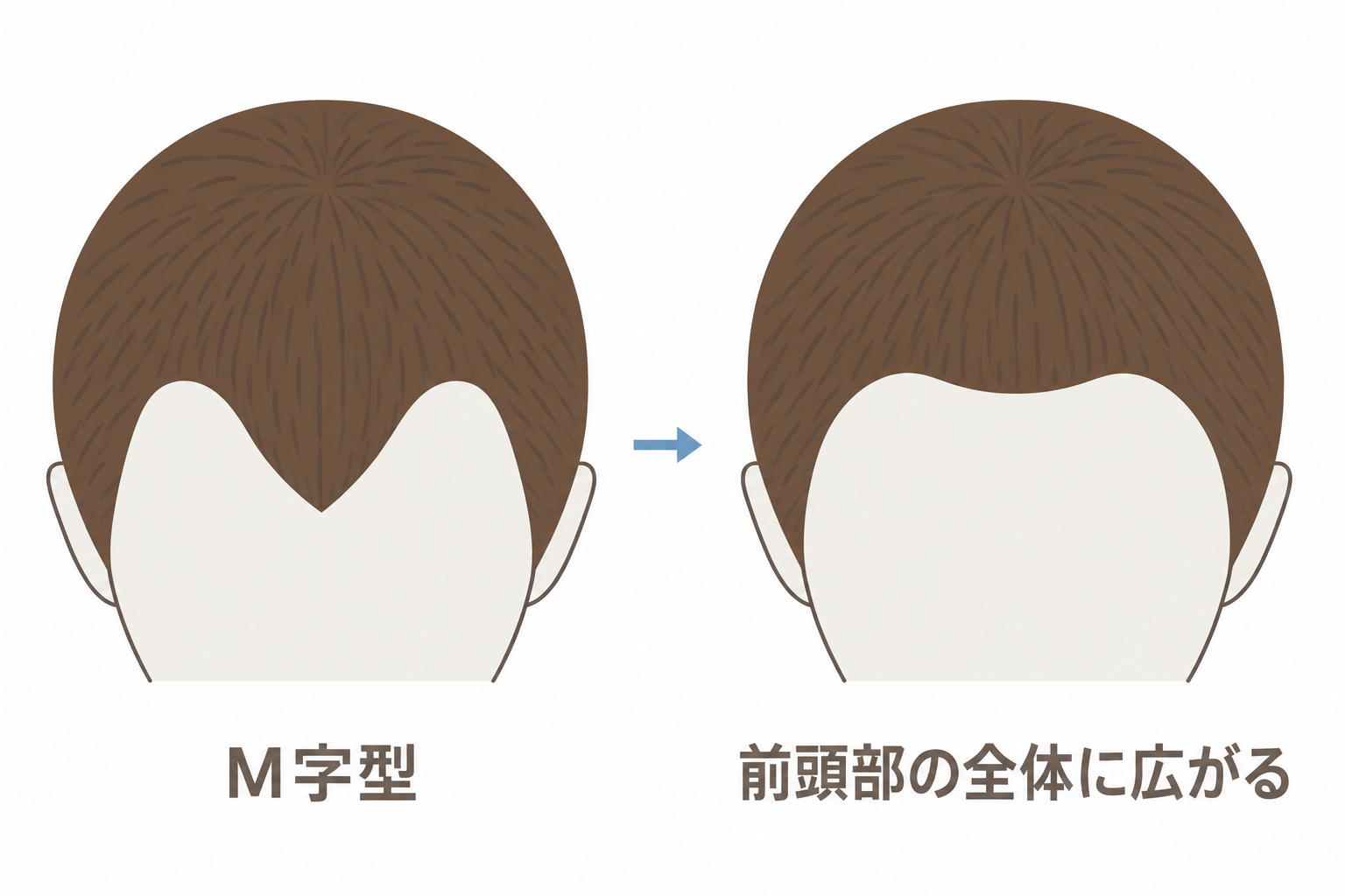 M字型が進行すると前頭部の全体に広がる