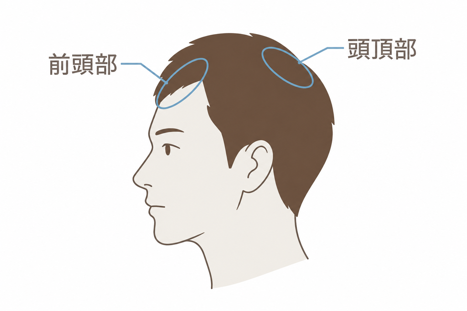 薄毛が気になりやすい部位。前頭部と頭頂部