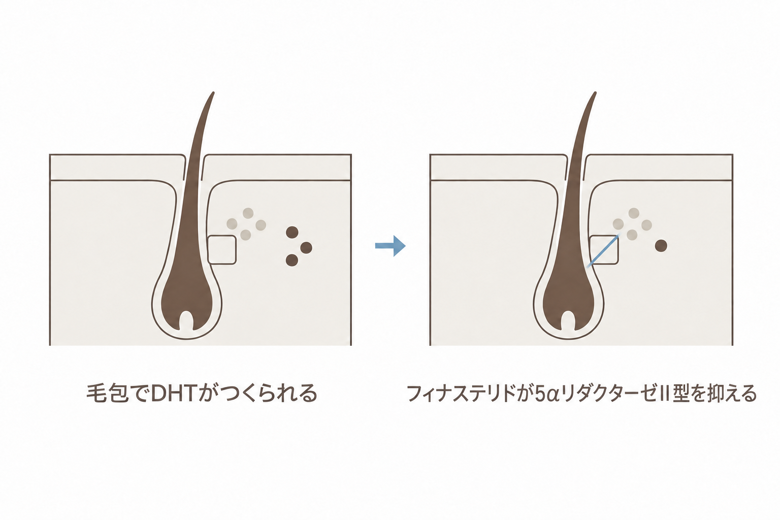 フィナステリドが毛包の5αリダクターゼⅡ型を抑える