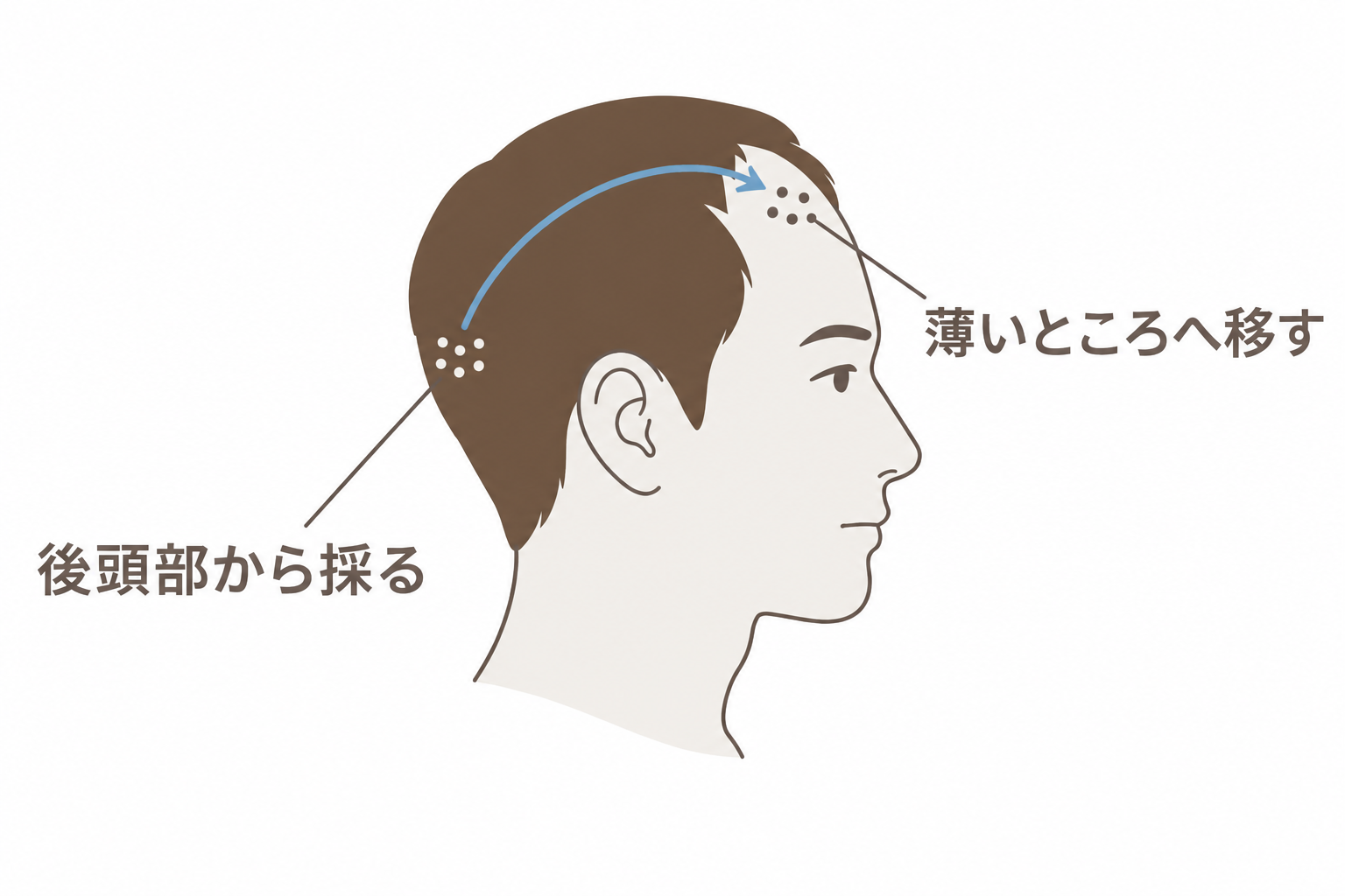 自毛植毛。後頭部から採って薄いところへ移す