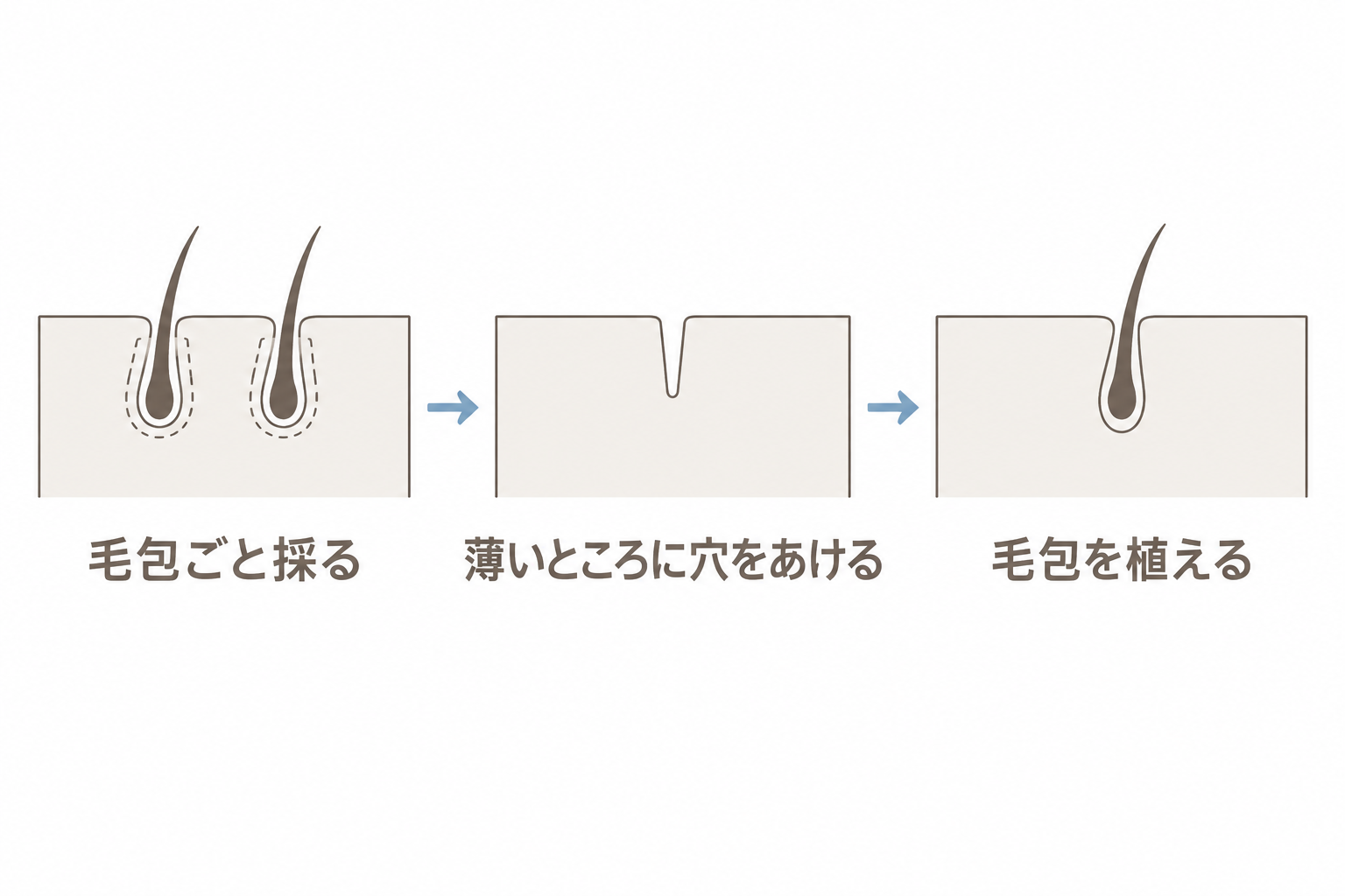 毛包ごと採って、薄いところに植える