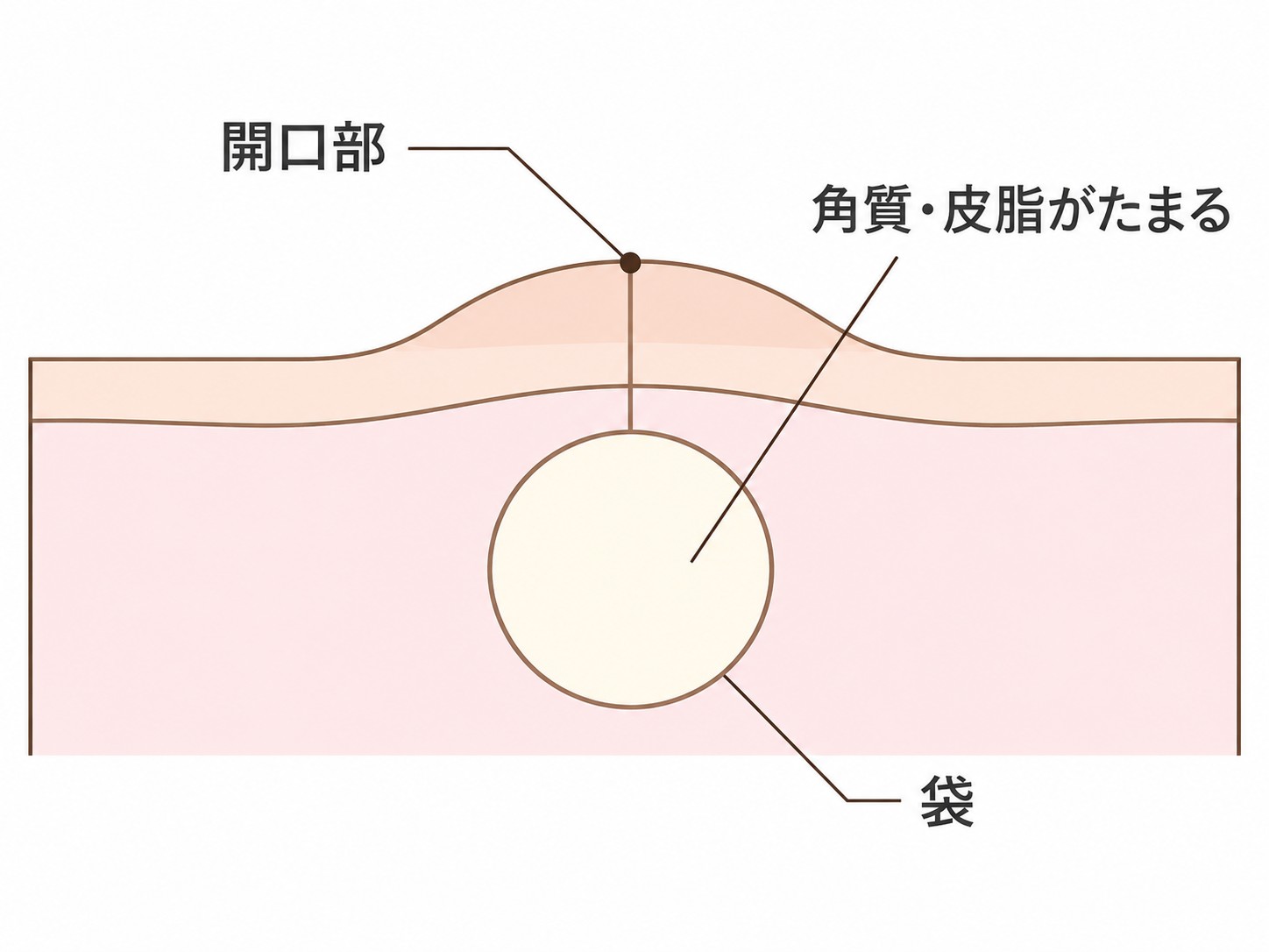皮膚の開口部につながる袋に角質・皮脂がたまった粉瘤の断面図
