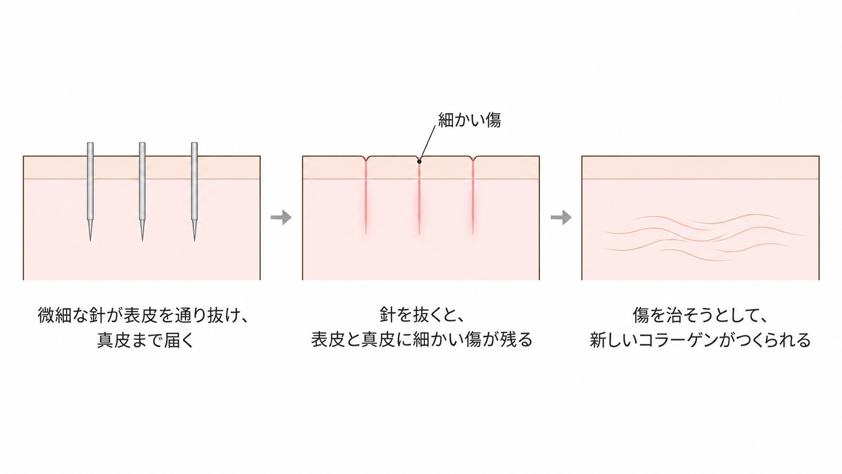 ダーマペンの仕組み。微細な針が真皮まで届き、抜いたあとに残る細かい傷を治そうとして新しいコラーゲンがつくられる