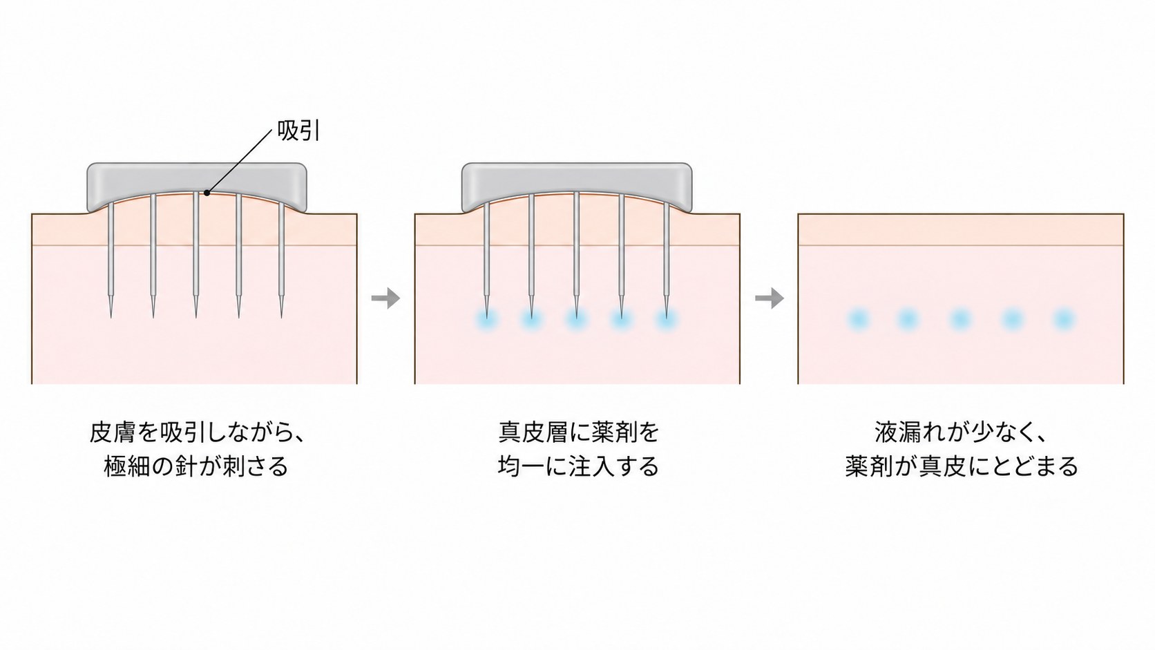 ハイコックス水光注射の仕組み。皮膚を吸引しながら極細の針で真皮層に薬剤を注入し、液漏れを抑える
