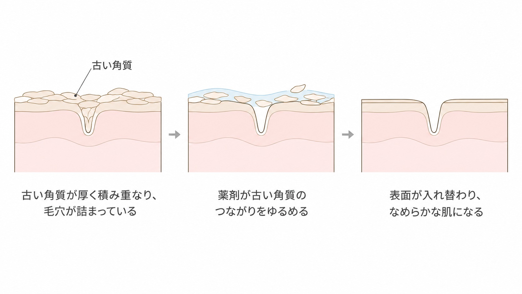ケミカルピーリングで古い角質のつながりがゆるみ、表面が入れ替わるまでの流れ