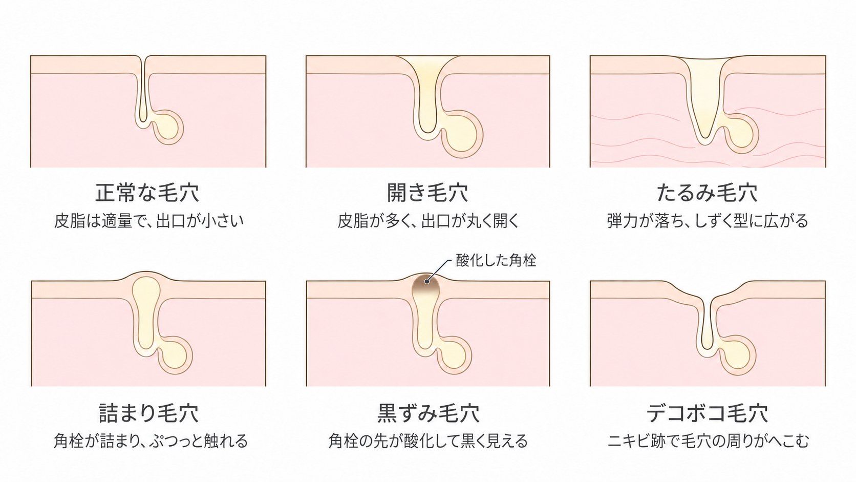 毛穴の6つのタイプの断面図。正常な毛穴、開き毛穴、たるみ毛穴、詰まり毛穴、黒ずみ毛穴、デコボコ毛穴
