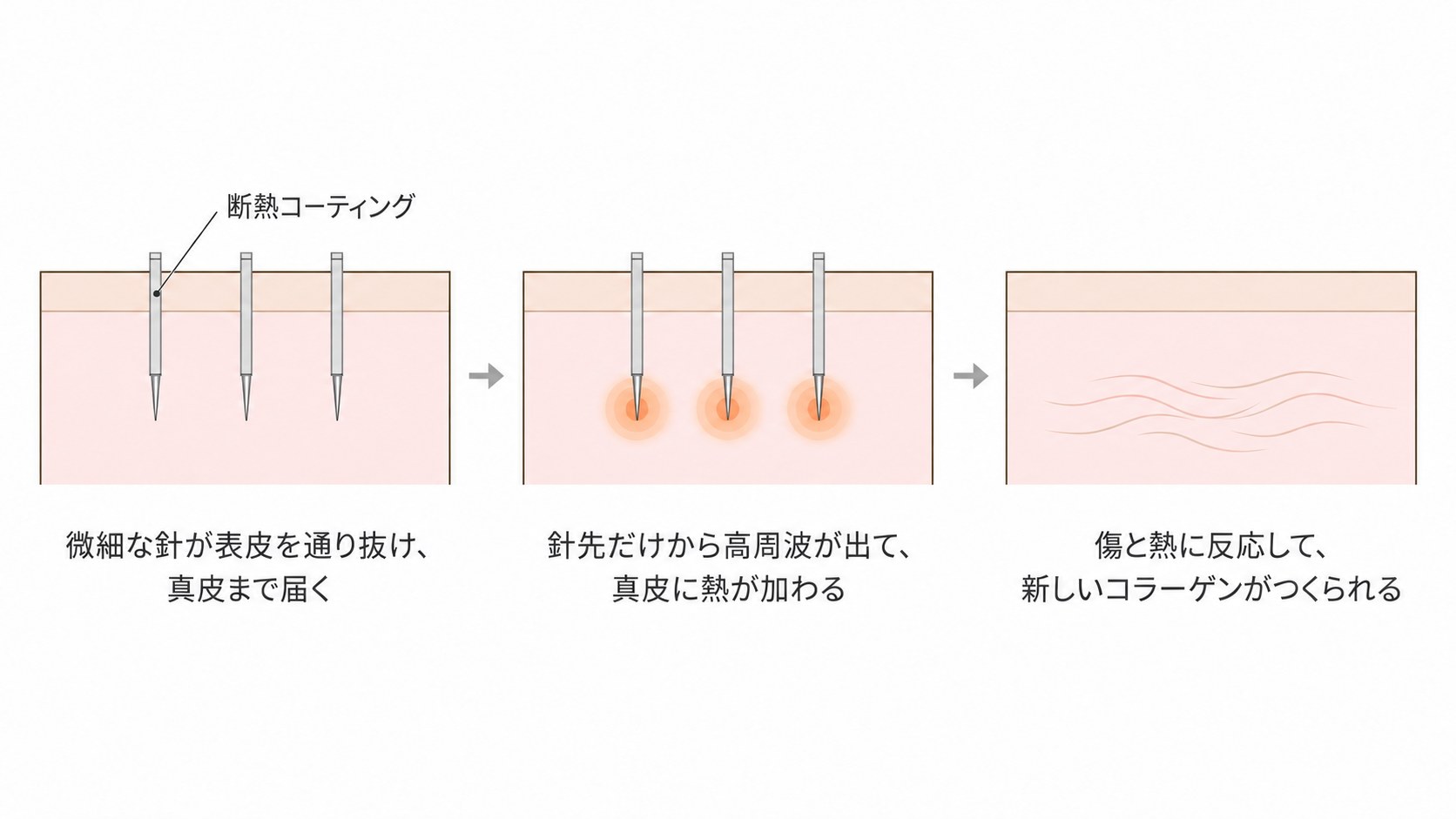 マイクロニードリングRFの仕組み。微細な針が真皮まで届き、針先だけから高周波が出て熱が加わり、新しいコラーゲンがつくられる