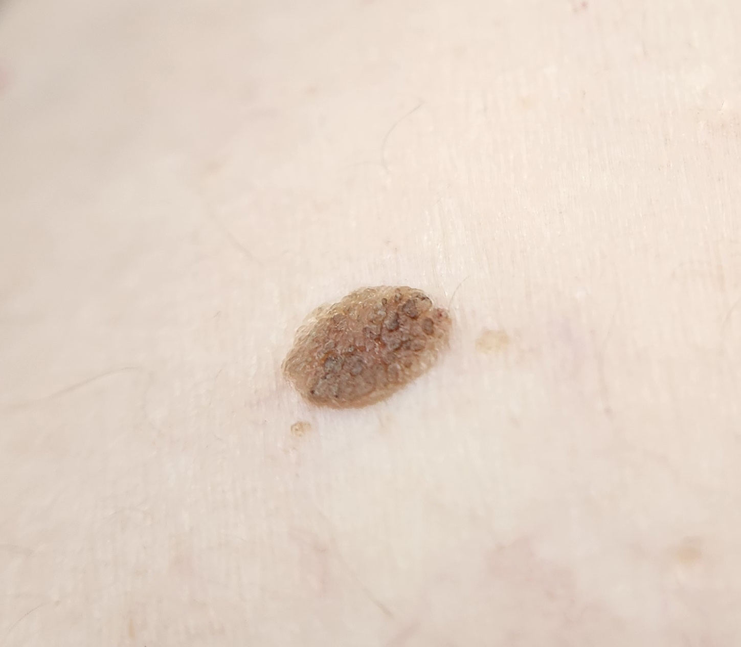 脂漏性角化症（老人性イボ）。境界がはっきりした茶色のできもので、表面がざらついて皮膚に貼り付いたように盛り上がっている