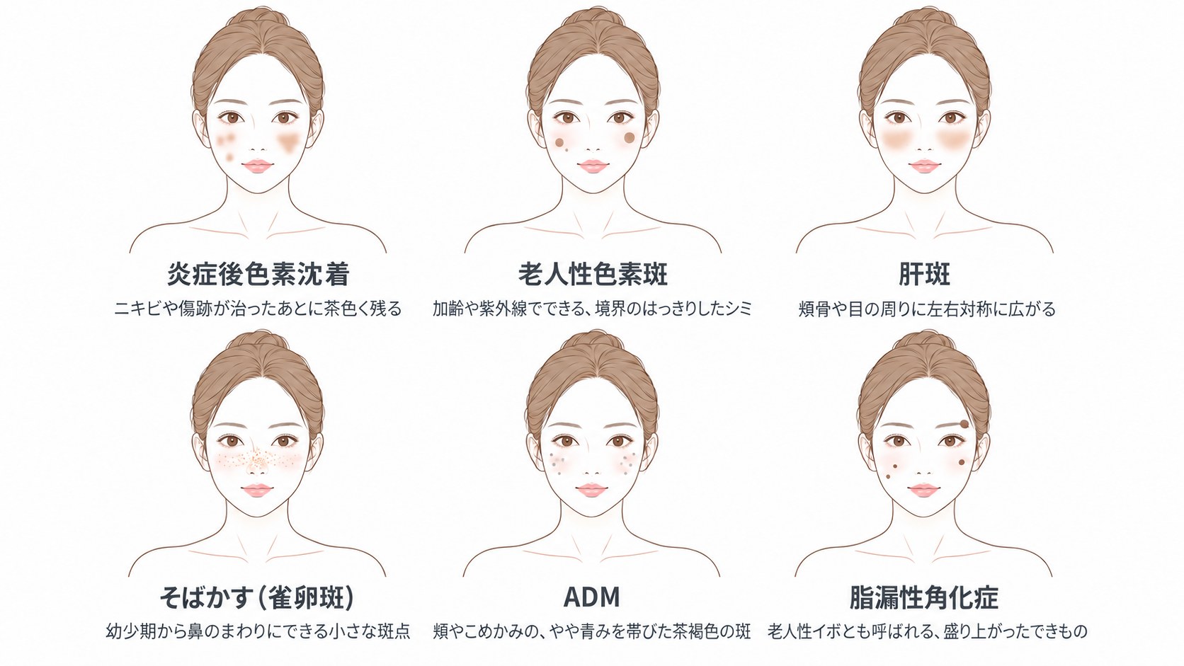 シミの6つの種類。炎症後色素沈着、老人性色素斑、肝斑、そばかす（雀卵斑）、ADM、脂漏性角化症の出方の違い