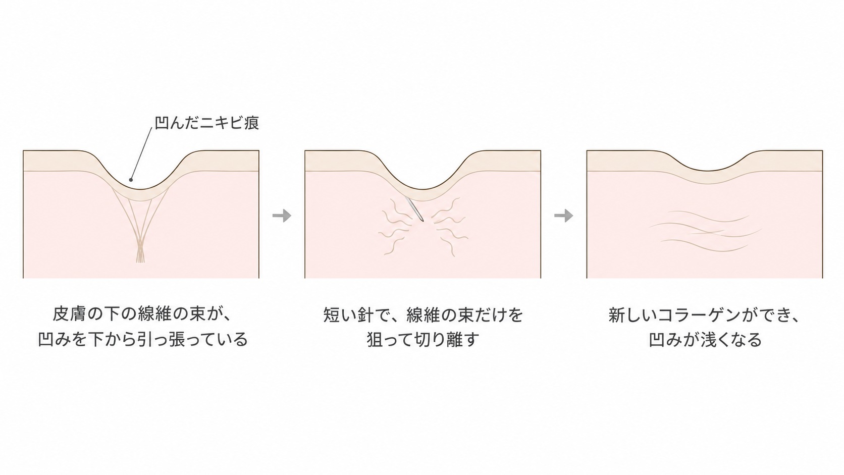 サブシジョンで線維の束を切り離し、凹んだニキビ痕が浅くなるまでの流れ