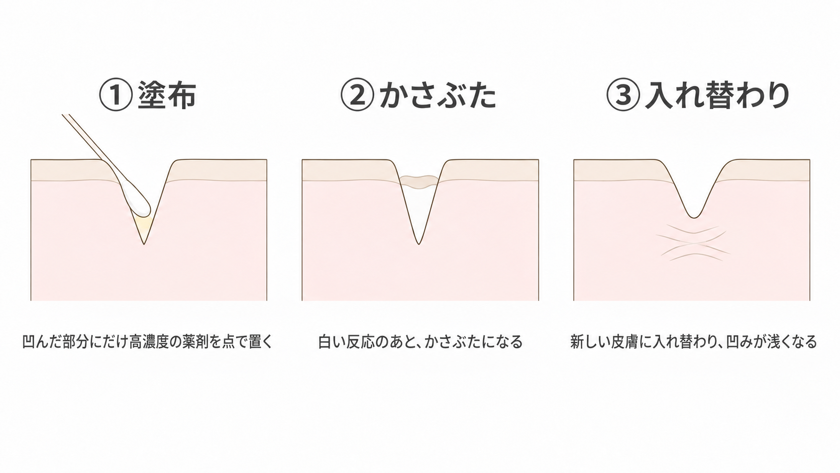 TCAクロスの施術の流れ