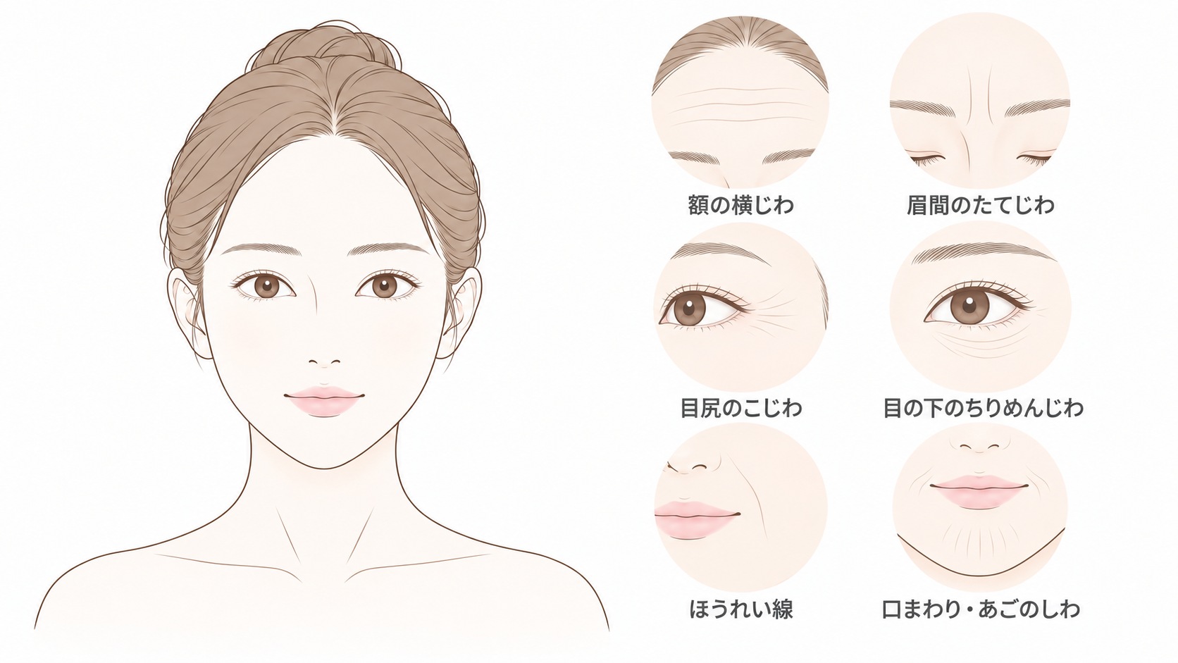 シワができやすい部位。額の横じわ、眉間のたてじわ、目尻のこじわ、目の下のちりめんじわ、ほうれい線、口まわり・あごのしわ